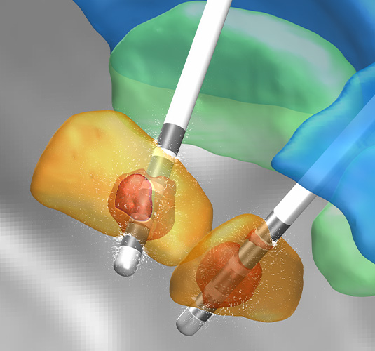 Feko wird zur Verringerung der Erwärmung während eines MRT zur Tiefhirnstimulation am Sunnybrook Research Institute eingesetzt